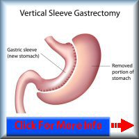 Gastric sleeve surgery in France